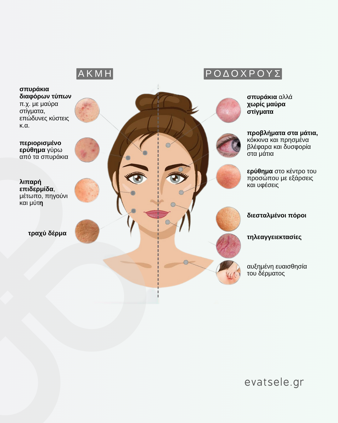 rosacea_website